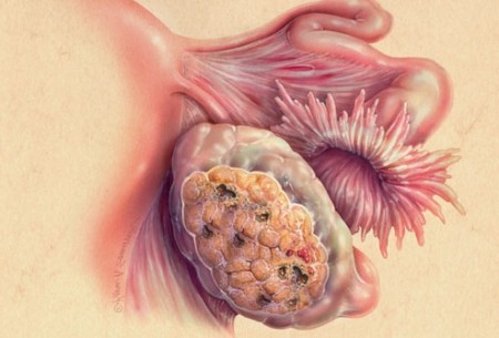 Злокачественные опухоли женских половых органов: Рак яичников